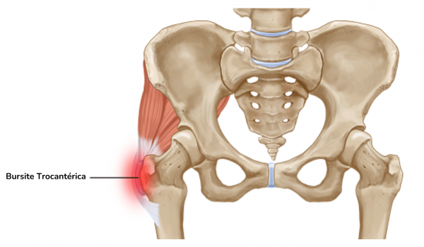 O que é Bursite Trocantérica?