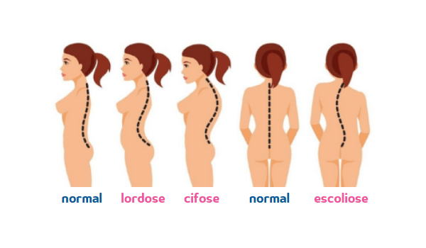 COLUNA] Desvios posturais: escoliose, lordose, cifose - Equilíbrio