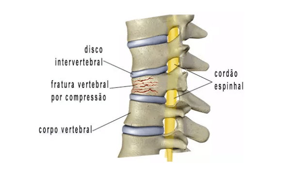 fratura-vertebral-2